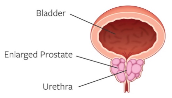 Abnormal Prostate