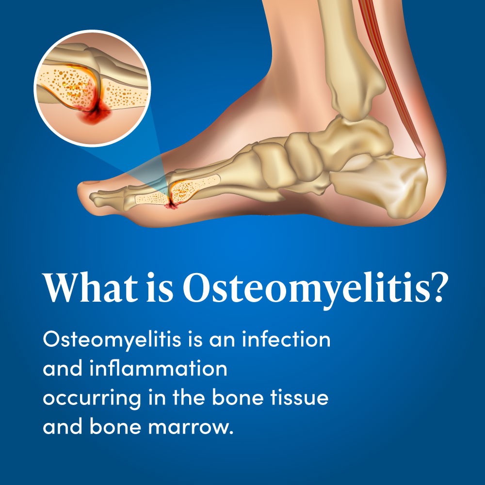What is Osteomyelitis?